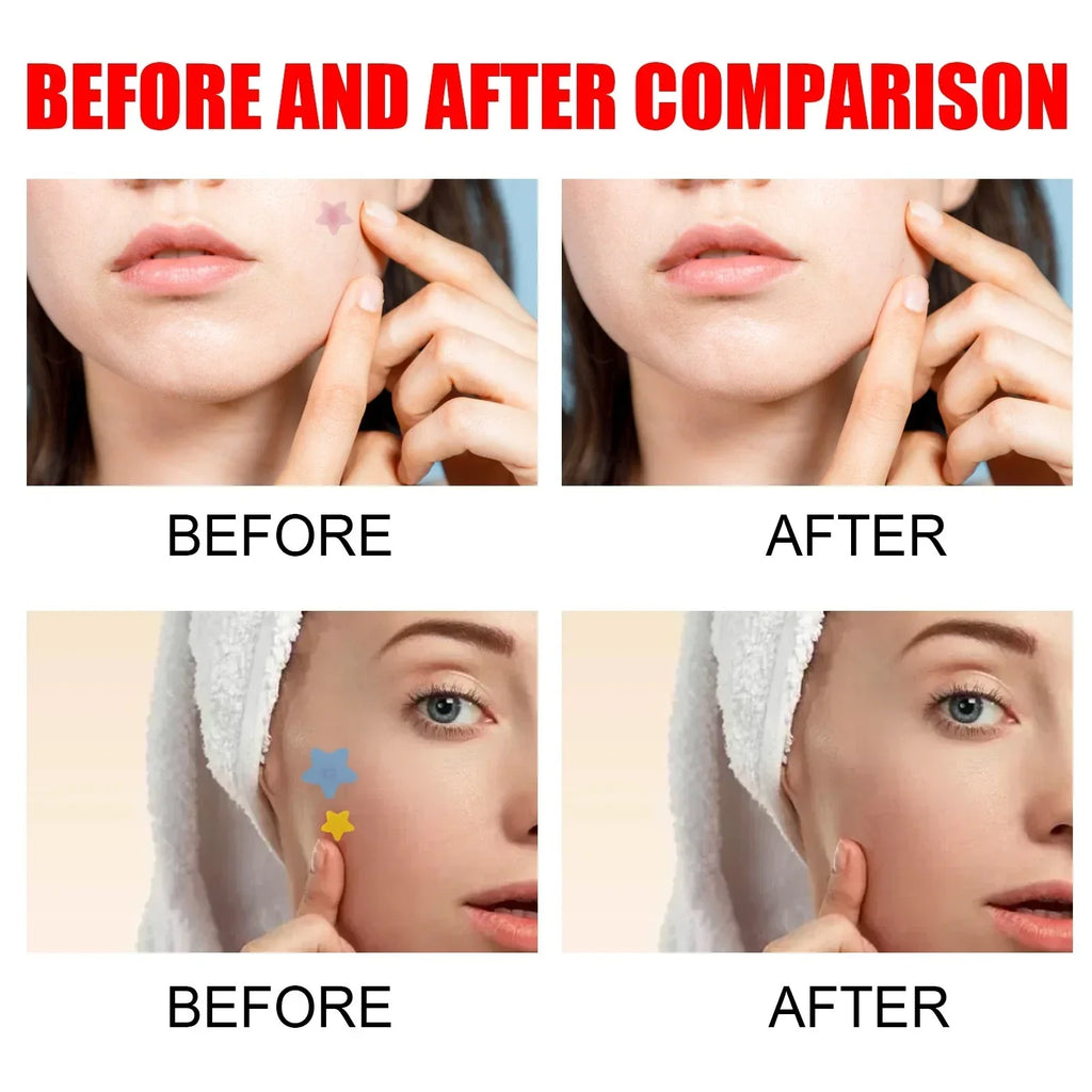 Pimple Patches,Pimple Patches For Face, Hydrocolloid Acne Patches, Cute Star Sti-Shop